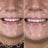 Whitens teeth by up to 6 shades